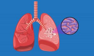 Uitleg van tuberculose in Kenia